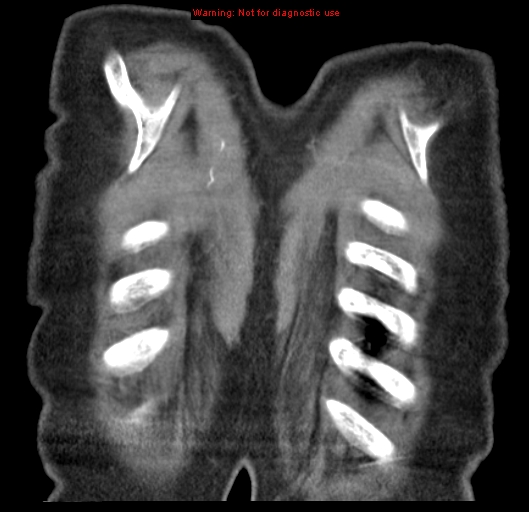 Bronchoalveolar carcinoma (BAC) (Radiopaedia 13436-13392 E 58).jpg
