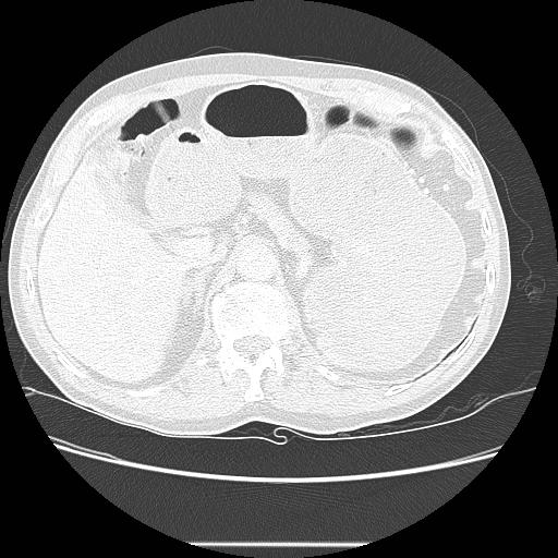 File:Bronchocele (Radiopaedia 17097-16795 Axial lung window 118).jpg