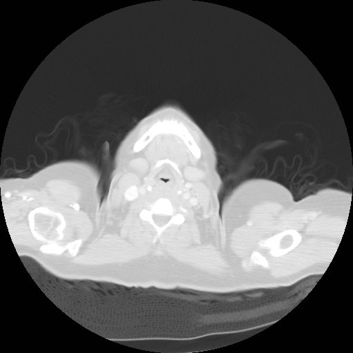 Bronchogenic carcinoma (Radiopaedia 73497-84262 Axial lung window 7).jpg