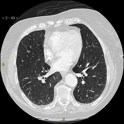 Bronchogenic carcinoma as an incidental finding (Radiopaedia 16453-16130 Axial lung window 49).jpg