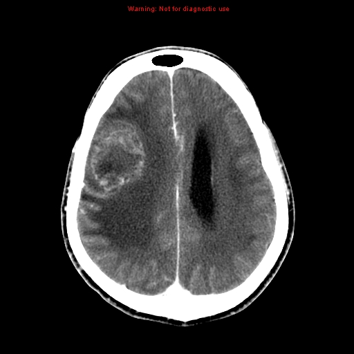 File:Bronchogenic carcinoma brain metastasis (Radiopaedia 9286-9970 B 20).jpg