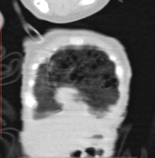 Bronchogenic cyst (Radiopaedia 78599-91409 Coronal lung window 29).jpg