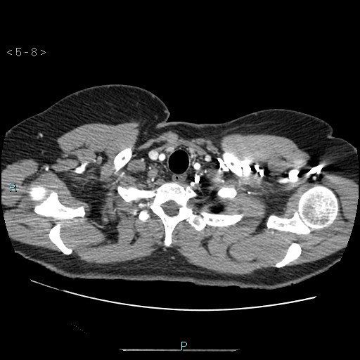 Bronchogenic cyst - posterior mediastinal (Radiopaedia 43885-47364 A 5).jpg