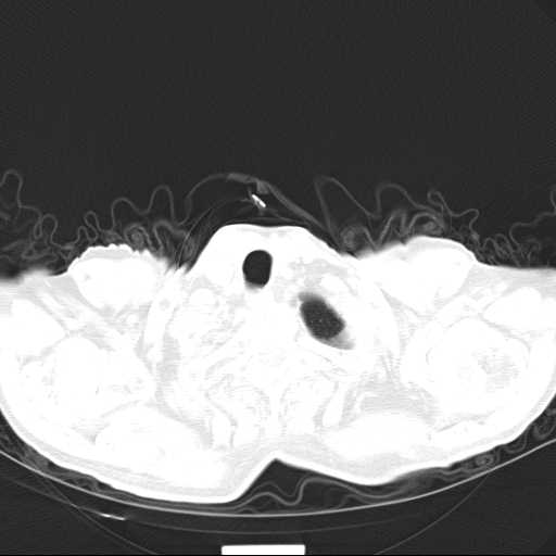 Bronchopleural fistula - postoperative complication (Radiopaedia 21020-20947 Axial lung window 2).jpg