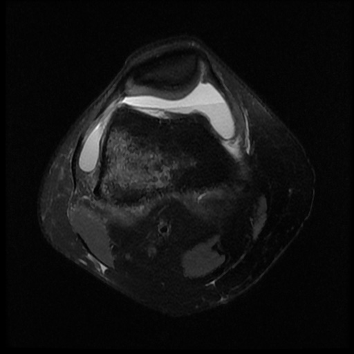 File:Bucket handle meniscus tear (Radiopaedia 56916-63751 Axial PD fat sat 4).jpg