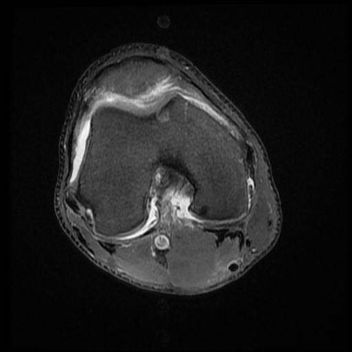 File:Bucket handle tear - medial meniscus (Radiopaedia 69245-79026 Axial PD fat sat 9).jpg