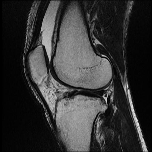 File:Bucket handle tear - medial meniscus (Radiopaedia 69245-79026 Sagittal T2 3).jpg