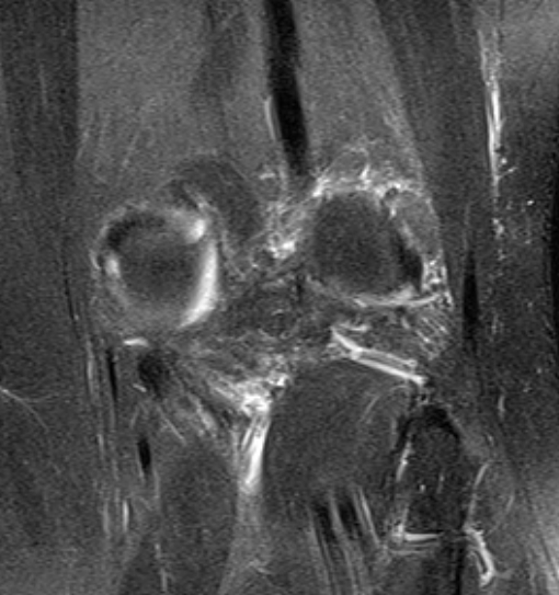 File:Bucket handle tear - medial meniscus (Radiopaedia 79028-91942 Coronal PD fat sat 2).jpg