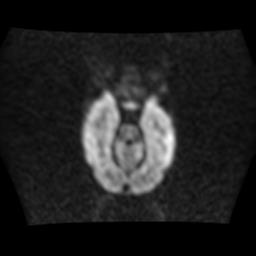 File:Burkitt lymphoma of the orbit- pre and post chemotherapy (Radiopaedia 31214-31930 Axial DWI 6).jpg