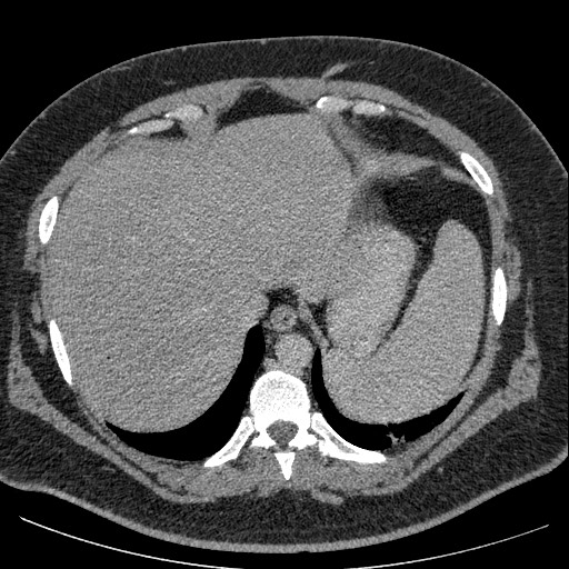 File:Burned-out testicular seminoma - retroperitoneal nodal metastases (Radiopaedia 62872-71245 A 11).jpg