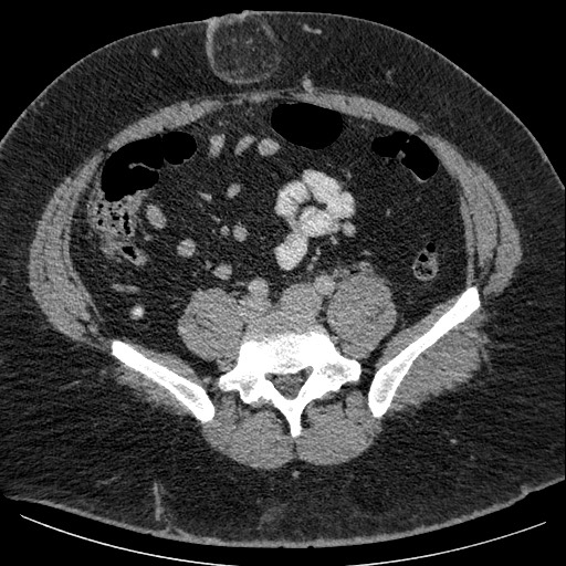 Burned-out testicular seminoma - retroperitoneal nodal metastases (Radiopaedia 62872-71245 A 50).jpg