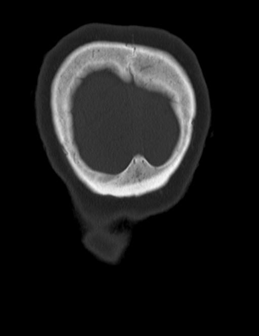 Burnt-out meningioma (Radiopaedia 51557-57337 Coronal bone window 53).jpg