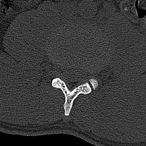 File:Burst fracture (Radiopaedia 53373-59357 Axial bone window 39).jpg