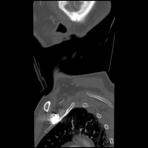 File:C1 anterior arch (plough) fracture - type 1 (Radiopaedia 76181-87720 Sagittal bone window 7).jpg