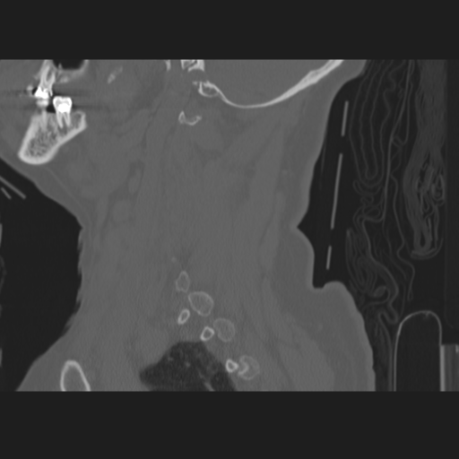 C2 fracture (Radiopaedia 34091-35341 Sagittal bone window 57).png
