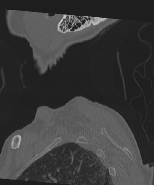 C2 fracture with vertebral artery dissection (Radiopaedia 37378-39199 Sagittal bone window 3).png