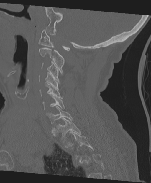 C2 fracture with vertebral artery dissection (Radiopaedia 37378-39199 Sagittal bone window 50).png
