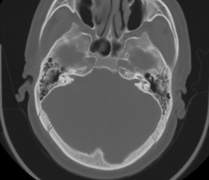 C7 laminar fracture and Klippel-Feil syndrome (Radiopaedia 86710-102850 Axial bone window 10).jpg