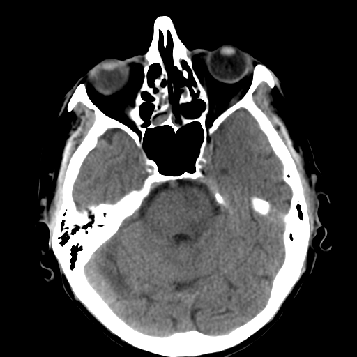 File:CNS lymphoma (Radiopaedia 36983-38639 Axial non-contrast 14).png