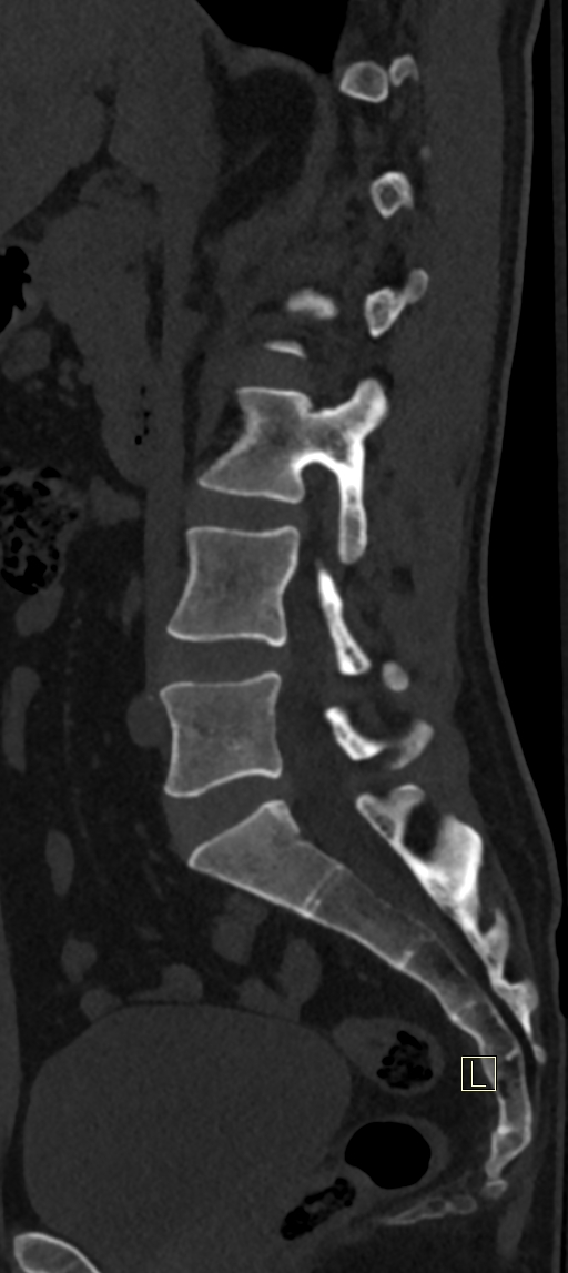 Calcaneal fractures with associated L2 burst fracture (Radiopaedia 71671-82493 Sagittal bone window 48).jpg
