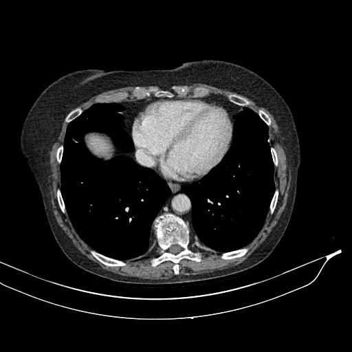 Calcified adrenal glands and Spigelian hernia (Radiopaedia 49741-54988 A 6).jpg