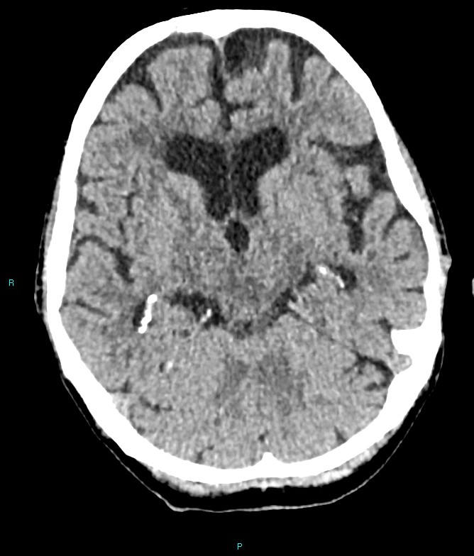 Calcified cerebral emboli from left ventricular thrombus (Radiopaedia 84420-99758 Axial non-contrast 58).jpg