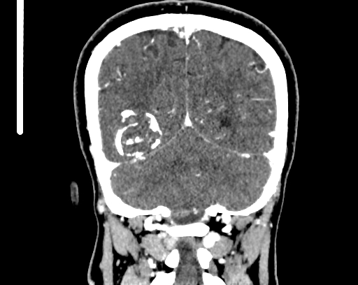 File:Calcified cerebral hydatid cyst (Radiopaedia 65603-74717 C 57).jpg