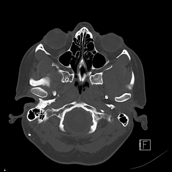 Calcified chronic subdural hematoma (Radiopaedia 77374-89492 Axial bone window 13).jpg