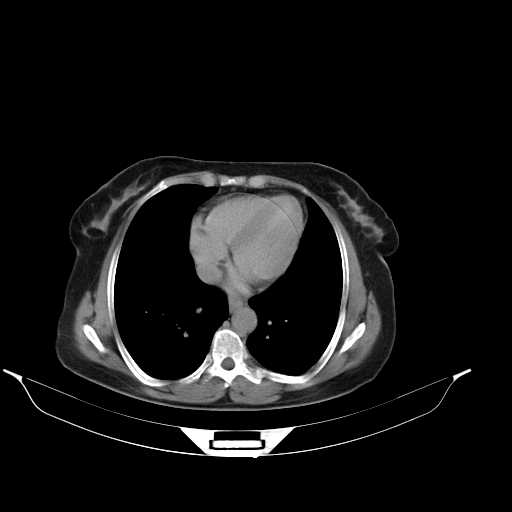 File:Calcified hydatid cyst of the liver (Radiopaedia 21212-21112 Axial C+ delayed 6).jpg