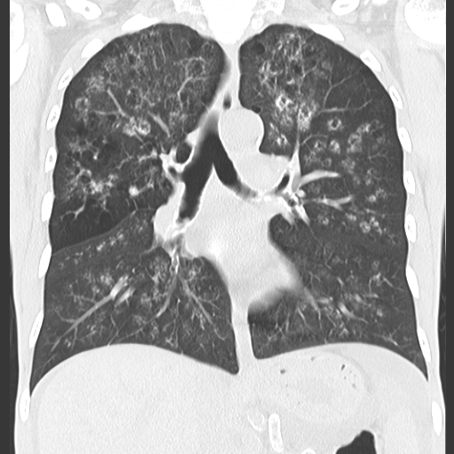 File:Calciphylaxis and metastatic pulmonary calcification (Radiopaedia 10887-11318 Coronal lung window 3).jpg