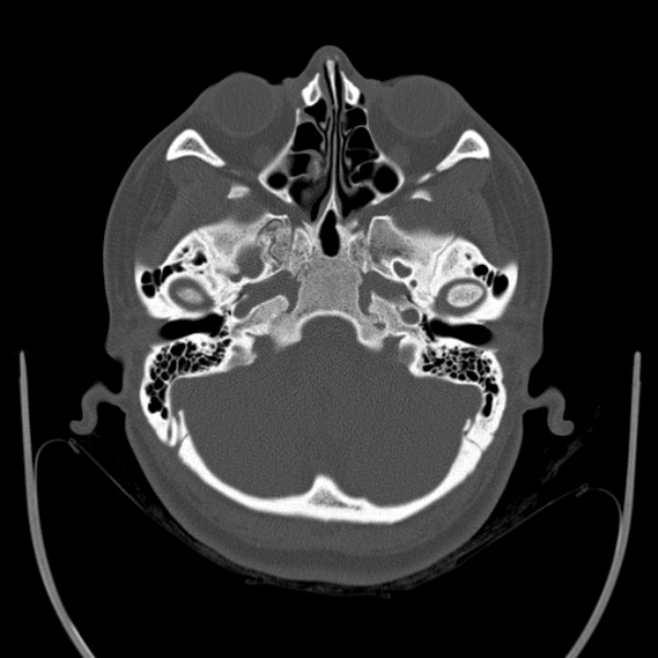 Calvarial osteoma (Radiopaedia 36520-38079 Axial bone window 22).jpg