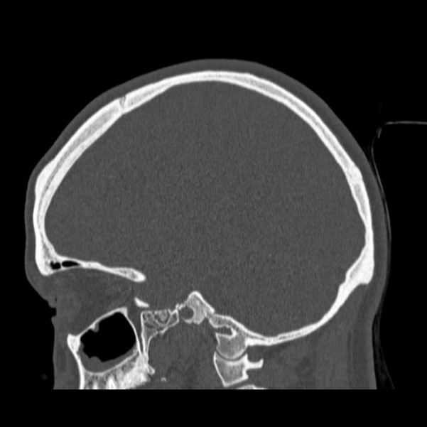 Calvarial osteoma (Radiopaedia 36520-38079 Sagittal bone window 43).jpg