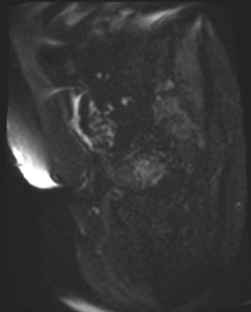 Cancer cervix - stage IIb (Radiopaedia 75411-86615 Sagittal DWI 44).jpg