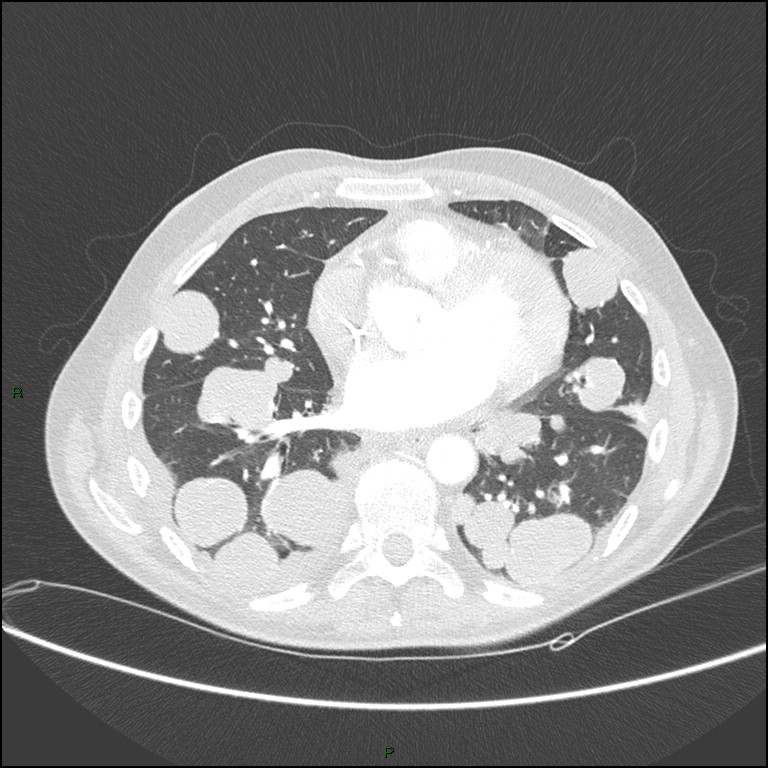Cannonball metastases (Radiopaedia 82110-96150 Axial lung window 122).jpg