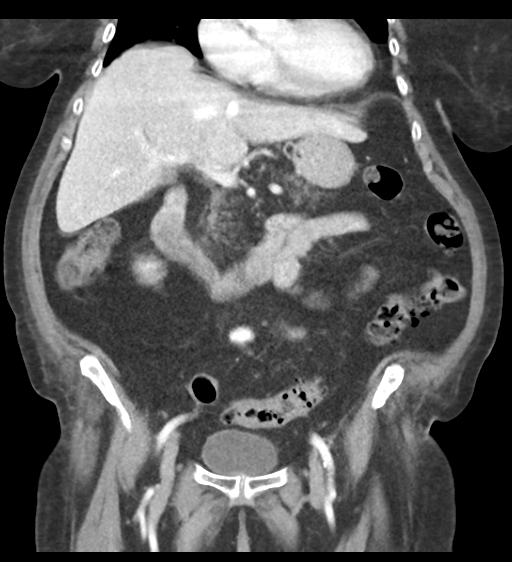 Cannonball metastases from endometrial cancer (Radiopaedia 42003-45031 F 32).png