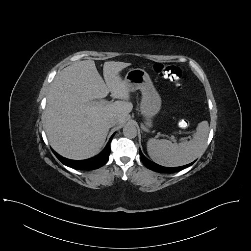 File:Carcinoid tumor - terminal ileum (Radiopaedia 60931-68740 Axial non-contrast 18).jpg