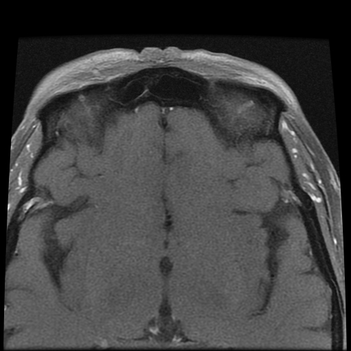 File:Carcinoid tumor of the ileum with metastasis to orbit (Radiopaedia 28165-28424 Axial T1 C+ fat sat 13).jpg