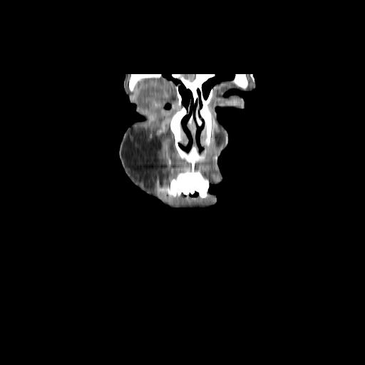 Carcinoma of the maxillary antrum (Radiopaedia 53805-59888 Coronal C+ delayed 10).jpg