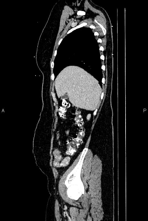 Carcinoma of uterine cervix (Radiopaedia 85861-101700 D 12).jpg