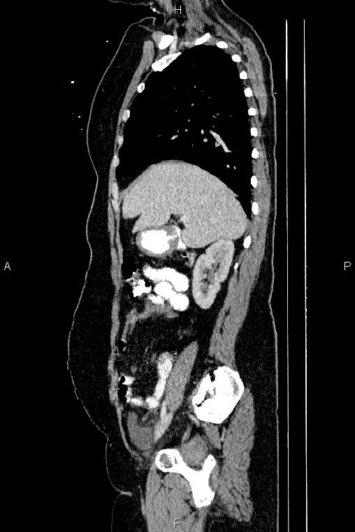 Carcinoma of uterine cervix (Radiopaedia 85861-101700 D 23).jpg