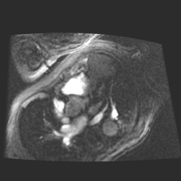 File:Cardiac fibroma (Radiopaedia 38974-41150 4 chamber FGRET 1).jpg