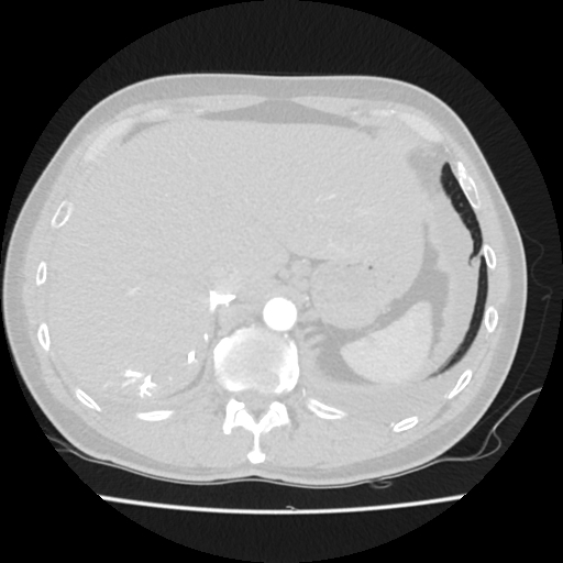 Cardiac tamponade (Radiopaedia 78607-91368 Axial lung window 90).jpg