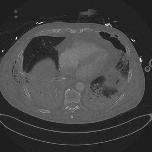Cardiac trauma (Radiopaedia 32874-33858 Axial bone window 64).jpg