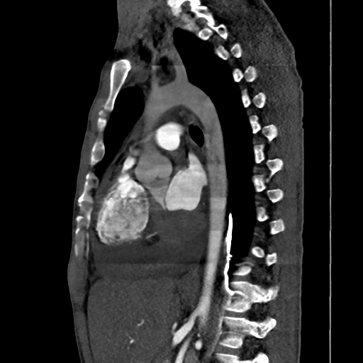 Cardiac tumor - undifferentiated pleomorphic sarcoma (Radiopaedia 45844-50134 B 34).png