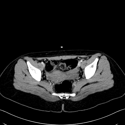 File:Caroli disease with medullary sponge kidney (Radiopaedia 82622-96804 C 67).jpg
