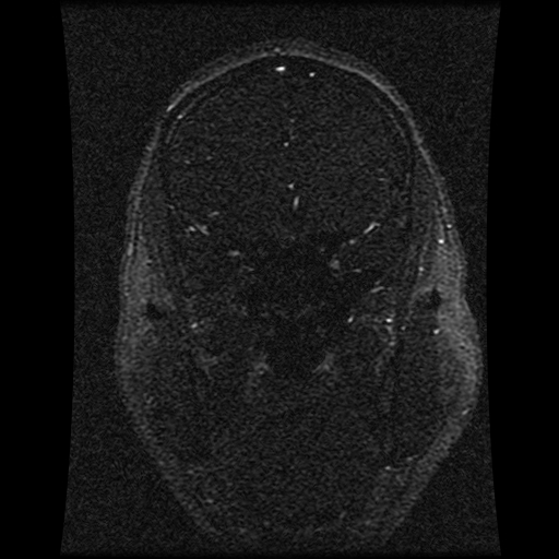 Carotid arterial dissection with acute cerebral infarction (Radiopaedia 26636-26784 MRV 117).jpg