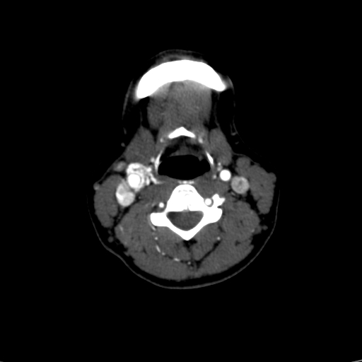 File:Carotid body tumor (Radiopaedia 39845-42300 B 28).jpg