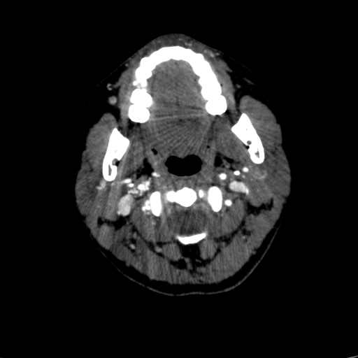 File:Carotid body tumor (Radiopaedia 39845-42300 B 59).jpg