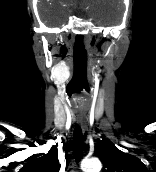 Carotid body tumor (Radiopaedia 39845-42300 C 24).jpg