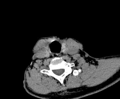 File:Carotid body tumor (Radiopaedia 61750-69757 Axial non-contrast 86).jpg